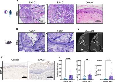 The role of S100A8 and S100A9 in external auditory canal cholesteatoma